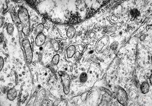 M,1y. | neuroblastoma - retroperitoneum